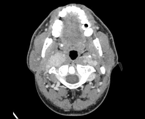 Bilateral carotid body tumors (Radiopaedia 61841-69870 Axial Post contrast 24).jpg