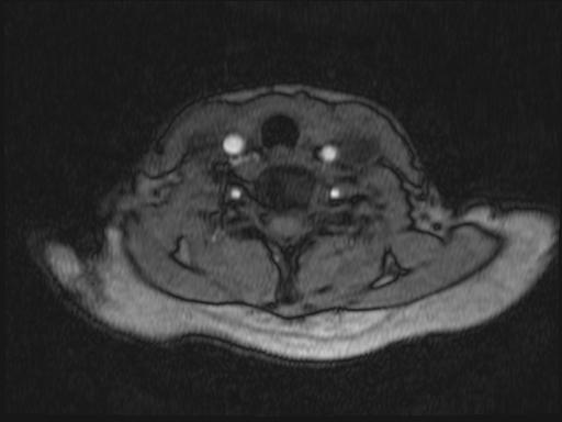 Bilateral carotid body tumors and right glomus jugulare tumor (Radiopaedia 20024-20060 Axial MRA 210).jpg