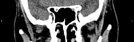 File:Bilateral enlargement of lacrimal glands - sarcoidosis (Radiopaedia 62627-70921 Coronal non-contrast 22).jpg