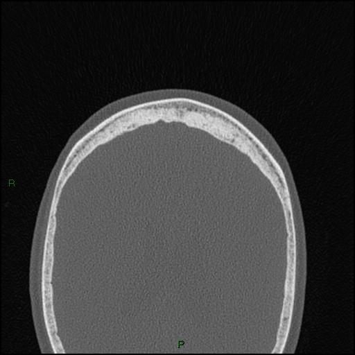 Bilateral frontal mucoceles (Radiopaedia 82352-96454 Axial bone window 32).jpg