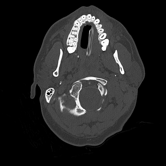 Bilateral occipital condyle fracture (type 2) (Radiopaedia 87675-104089 Axial bone thins 8).jpg