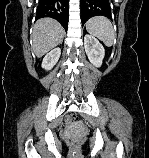 File:Bilateral ovarian dermoid cysts (Radiopaedia 85785-101603 C 45).jpg