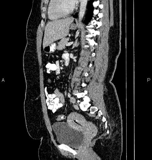 File:Bilateral ovarian dermoid cysts (Radiopaedia 85785-101603 D 54).jpg