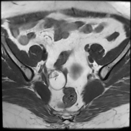 File:Bilateral ovarian dermoid cysts (Radiopaedia 90152-107338 Axial T1 8).jpg