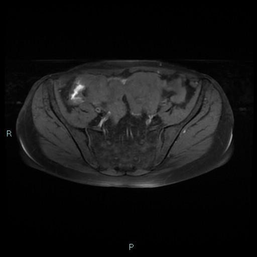 File:Bilateral ovarian fibroma (Radiopaedia 44568-48293 Axial T1 fat sat 8).jpg