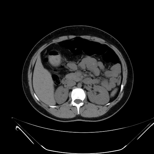 Bilateral ovarian mature cystic teratomas (Radiopaedia 79373-92457 Axial non-contrast 16).jpg