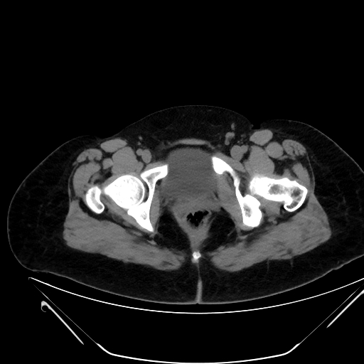 File:Bilateral ovarian mature cystic teratomas (Radiopaedia 79373-92457 Axial non-contrast 89).jpg