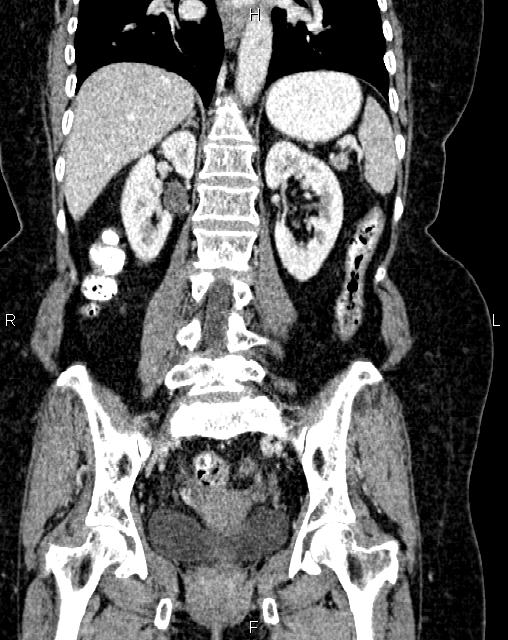 Bilateral ovarian serous cystadenocarcinoma (Radiopaedia 86062-101989 D 32).jpg