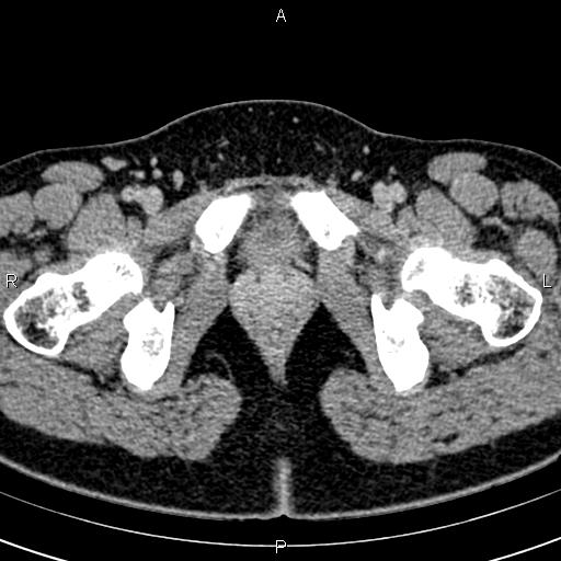 Bilateral ovarian teratoma (Radiopaedia 83131-97503 B 78).jpg
