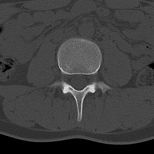 File:Bilateral pars defect (Radiopaedia 26691-26846 Axial bone window 6).jpg