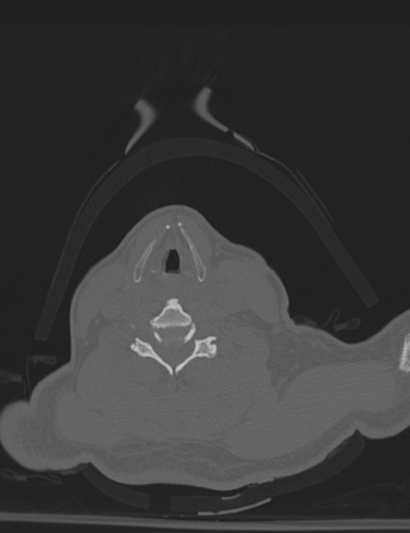 Bilateral perched facet joint (Radiopaedia 63149-71669 Axial bone window 40).jpg