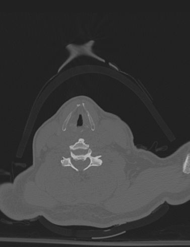 File:Bilateral perched facet joint (Radiopaedia 63149-71669 Axial bone window 41).jpg