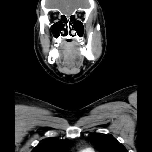 Bilateral peritonsillar abscess (Radiopaedia 85065-100610 Coronal 24).jpg