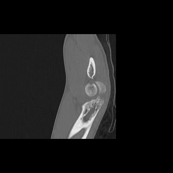 File:Bilateral proximal radioulnar synostosis (Radiopaedia 66532-75812 B 17).jpg