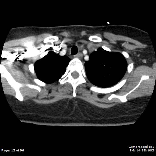 Bilateral pulmonary emboli with Hampton hump sign (Radiopaedia 54070-60246 Axial C+ CTPA 10).jpg