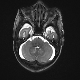 File:Bilateral subdural hemorrhage and parietal skull fracture (Radiopaedia 26058-26190 Axial T2 10).png
