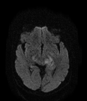 File:Bilateral thalamic glioma (Radiopaedia 65852-75009 Axial DWI 9).jpg