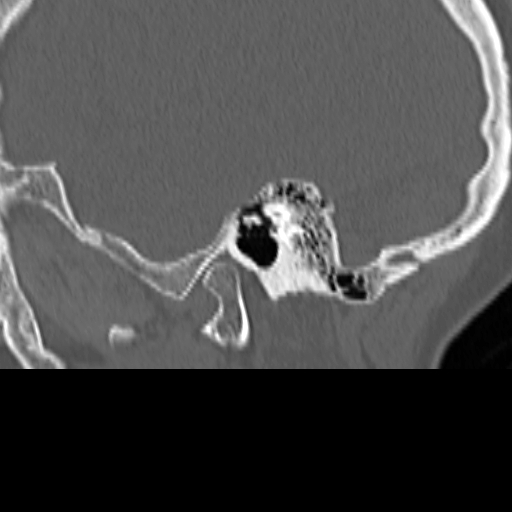 Bilateral tympanoplasty (Radiopaedia 16947-16664 Sagittal bone window 17).jpg