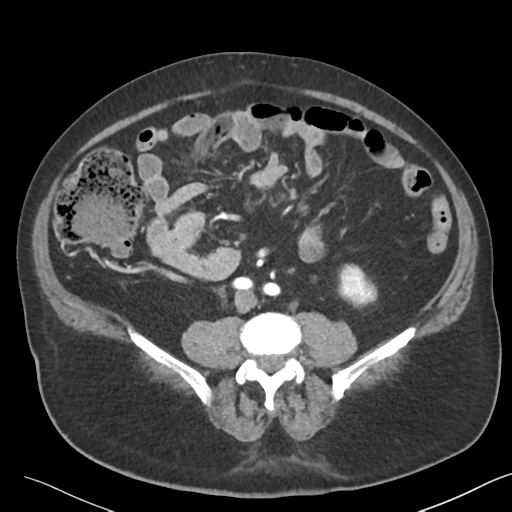 File:Bladder papillary urothelial carcinoma (Radiopaedia 48119-52951 A 32).png