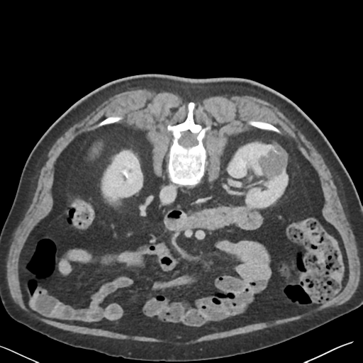 File:Bladder papillary urothelial carcinoma (Radiopaedia 48119-52951 Axial C+ delayed 18).png