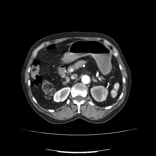 File:Bladder tumor detected on trauma CT (Radiopaedia 51809-57609 A 94).jpg