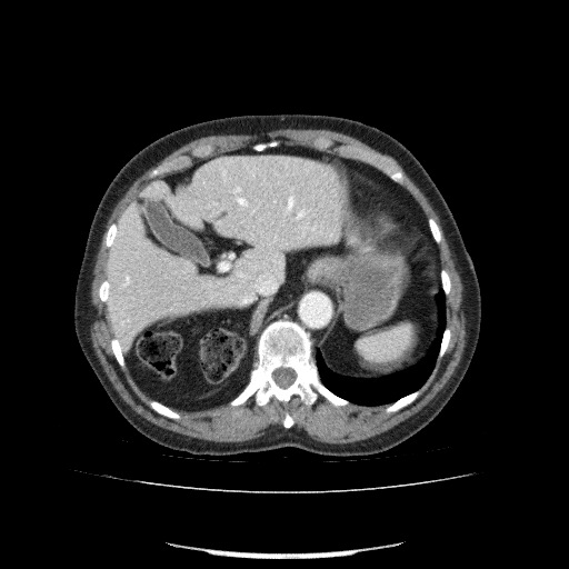 File:Bladder tumor detected on trauma CT (Radiopaedia 51809-57609 B 32).jpg