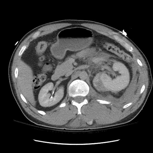 Blunt abdominal trauma with solid organ and musculoskelatal injury with active extravasation (Radiopaedia 68364-77895 Axial C+ delayed 50).jpg
