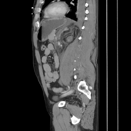 Blunt abdominal trauma with solid organ and musculoskelatal injury with active extravasation (Radiopaedia 68364-77895 C 92).jpg