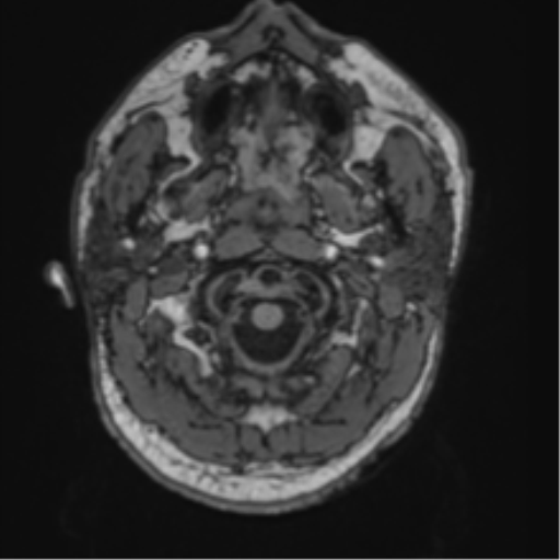 File:Blunt cerebrovascular injury (Radiopaedia 53682-59745 Axial T1 2).png