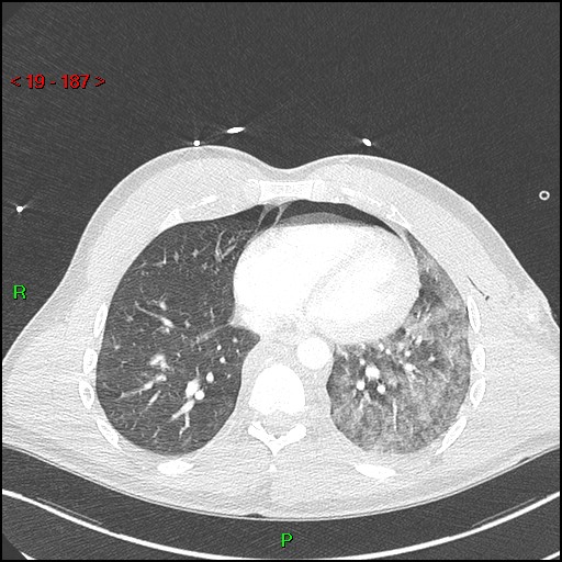 Blunt thoracic trauma (Radiopaedia 73454-84221 Axial lung window 68).jpg