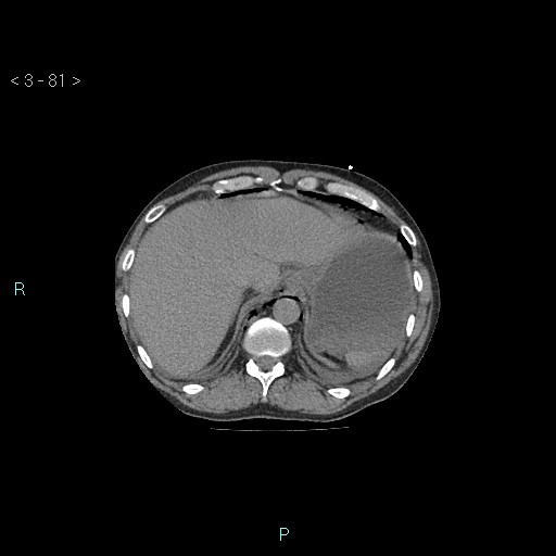 Boerhaave syndrome (Radiopaedia 27683-27897 Axial non-contrast 81).jpg