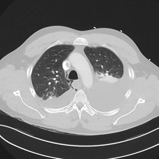 Boerhaave syndrome (Radiopaedia 39382-41660 Axial lung window 17).png