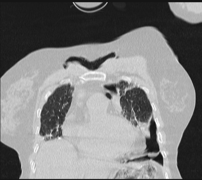 Boerhaave syndrome (Radiopaedia 45644-49799 Coronal lung window 18).jpg