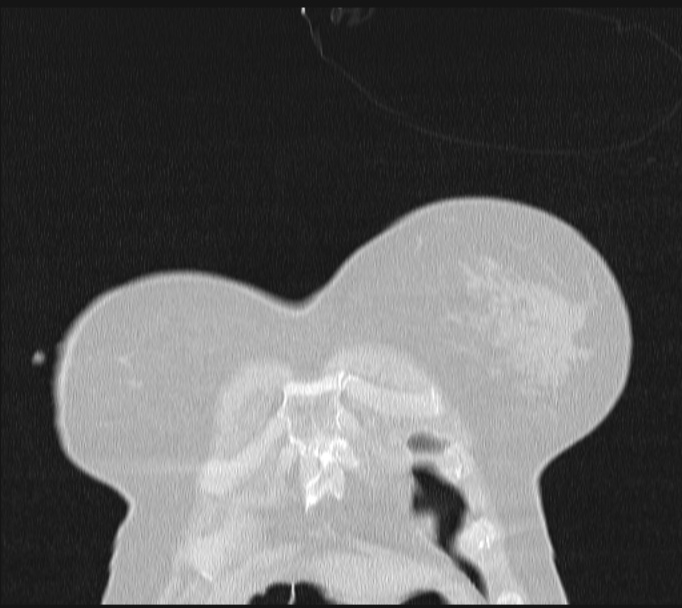 Boerhaave syndrome (Radiopaedia 45644-49799 Coronal lung window 5).jpg