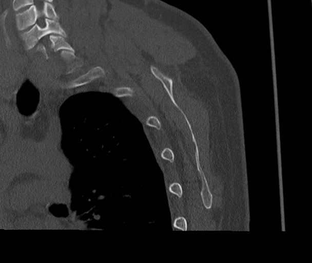 Bony Bankart and Hill-Sachs lesions (Radiopaedia 33622-34727 Sagittal bone window 68).png