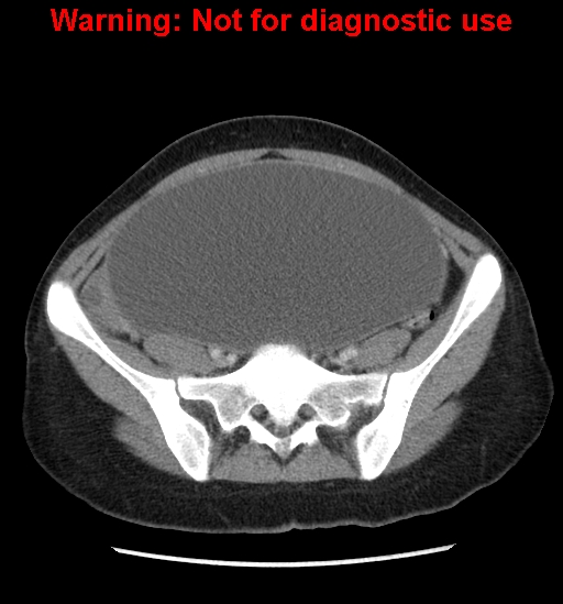 Borderline mucinous cystadenoma of ovary (Radiopaedia 25586-25767 A 72).jpg