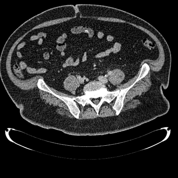 Bosniak renal cyst - type IV (Radiopaedia 24244-24518 C 283).jpg