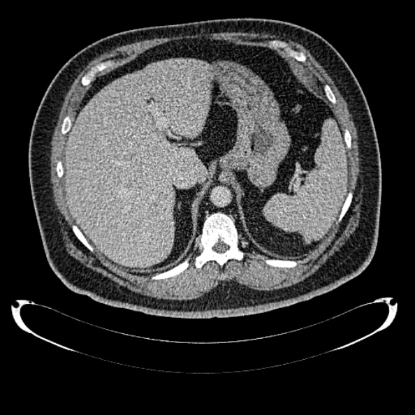 File:Bosniak renal cyst - type IV (Radiopaedia 24244-24518 C 60).jpg
