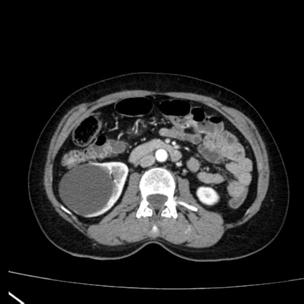Bosniak renal cyst - type I (Radiopaedia 27479-27675 renal cortical phase 40).jpg