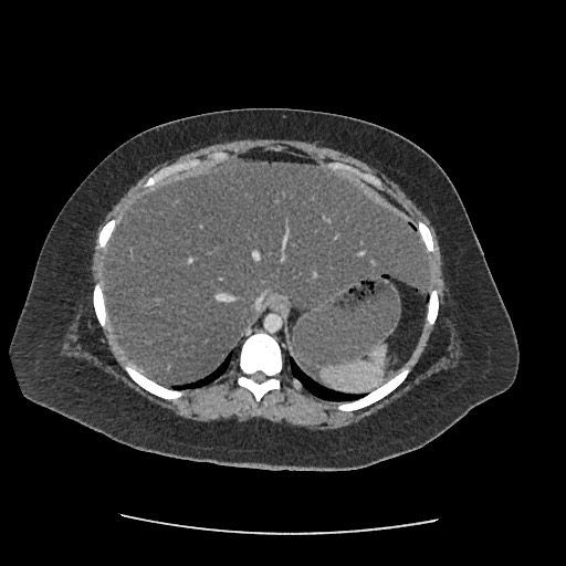 Bowel and splenic infarcts in acute lymphocytic leukemia (Radiopaedia 61055-68915 A 28).jpg