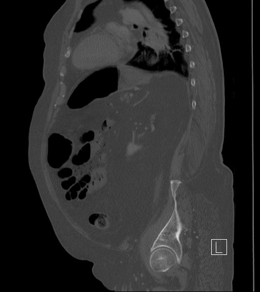 File:Bowel ischemia secondary to SMA occlusion with extensive portomesenteric venous gas (Radiopaedia 54656-60871 Sagittal bone window 33).jpg
