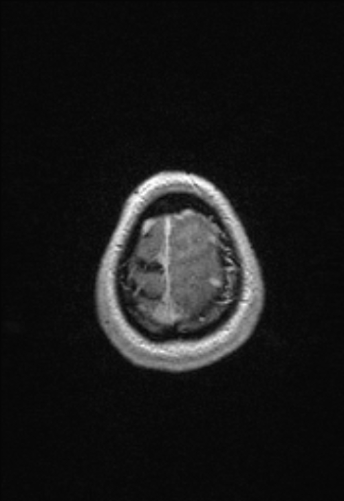 Brain abscess with ventriculitis (Radiopaedia 85703-101495 Axial T1 C+ 156).jpg