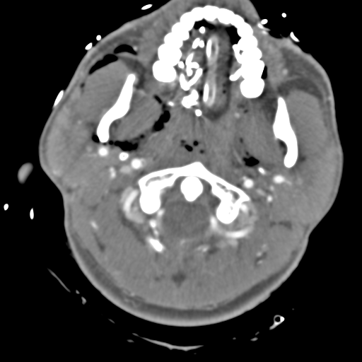 Brain contusions, internal carotid artery dissection and base of skull fracture (Radiopaedia 34089-35339 D 54).png