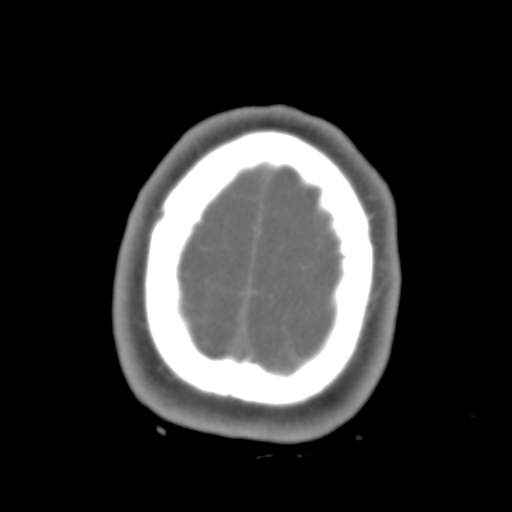 File:Brain contusions, internal carotid artery dissection and base of skull fracture (Radiopaedia 34089-35339 D 7).png