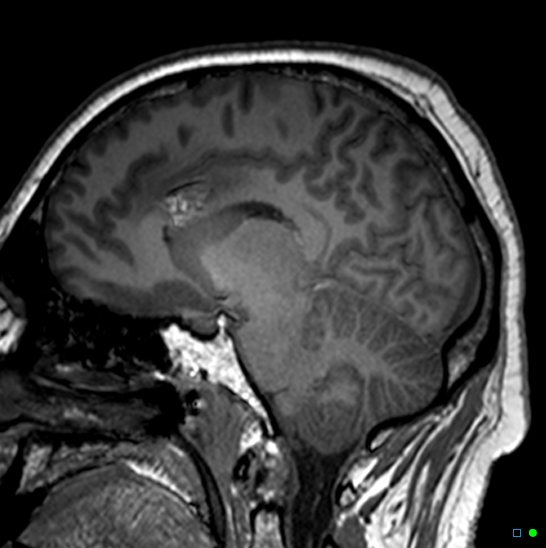 Brain death on MRI and CT angiography (Radiopaedia 42560-45689 Sagittal T1 16).jpg