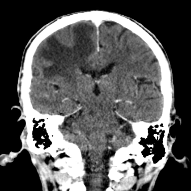 Brain metastases from lung cancer (Radiopaedia 27849-28092 Coronal C+ delayed 38).jpg