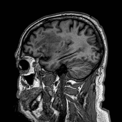 Brain metastases from lung cancer (Radiopaedia 83839-99028 Sagittal T1 32).jpg
