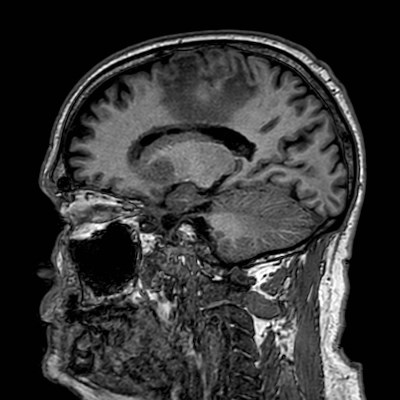 Brain metastases from lung cancer (Radiopaedia 83839-99028 Sagittal T1 80).jpg