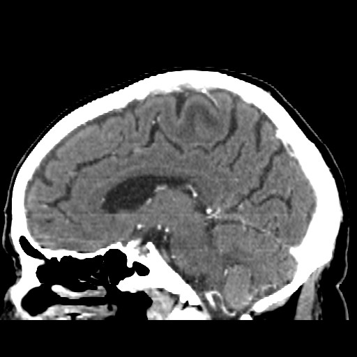 Brain metastasis (Radiopaedia 42617-45760 D 30).jpg