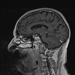 Brain metastasis (Radiopaedia 42617-45761 Sagittal T1 C+ 56).jpg